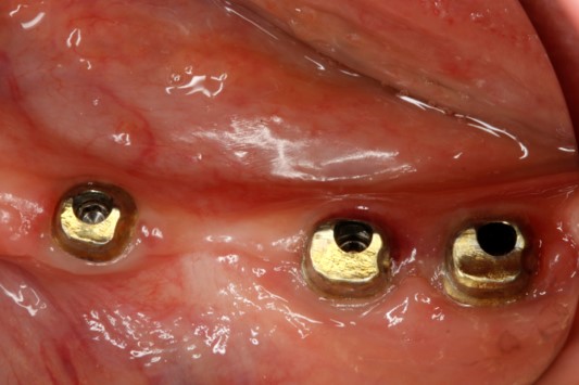 Final abutment for unilateral distal extension edentulous