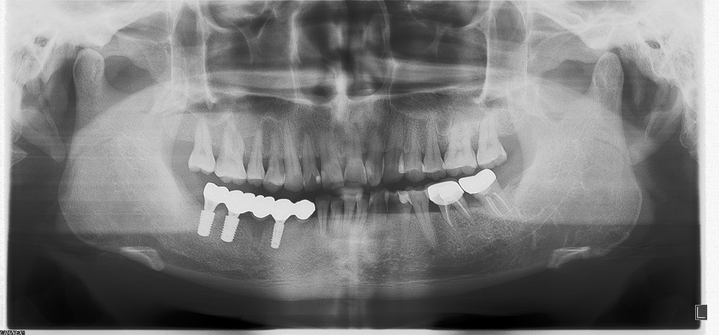 Patient result after unilateral distal extension edentulous restoration