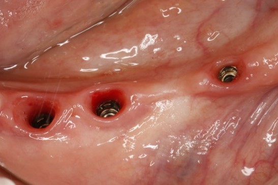 unilateral distal extension edentulous - intraoral photo