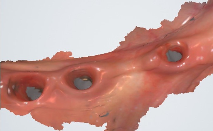 unilateral distal extension edentulous - intraoral 3D data 