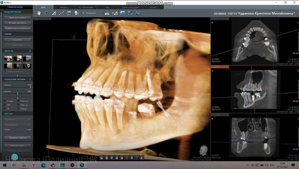 Final result after using Precise Implant Restoration Surgical Guide