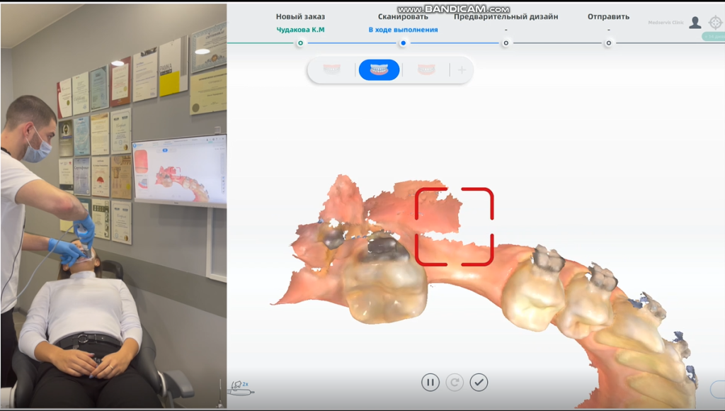 Real-time intraoral scan for Precise Implant Restoration Surgical Guide
