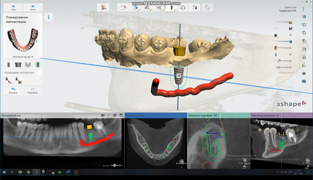 Neural tube modeling before Precise Implant Restoration Surgical Guide creation