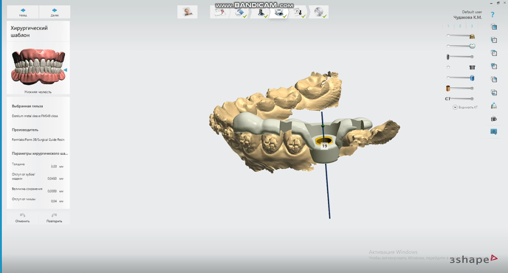 Designing the precise Implant Restoration Surgical Guide