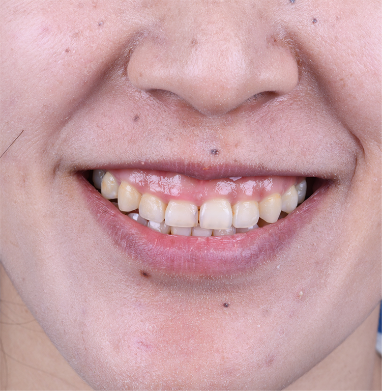 Patient smile before the all-ceramic veneer digital restoration