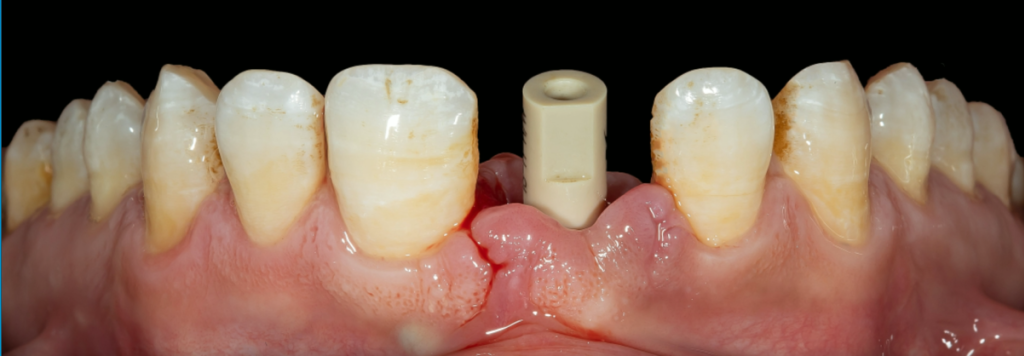 Digital Implant Aesthetic Restoration of Anterior Teeth