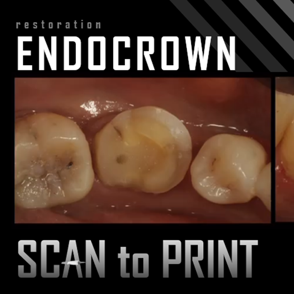 Endocrown from Scan to Print