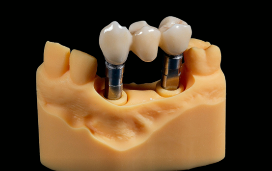 Fig. 11 - The final restorations fitted well in model (buccal view)