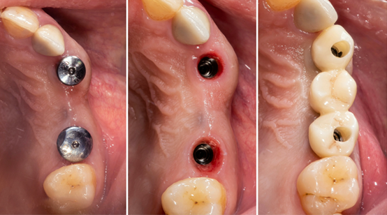 Fig. 13 - The left one is the implant body with healing cap on. The middle one shows a good condition of emergence. The right one is the final restoration placed in mouth.