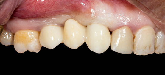 Fig. 14 - Final restorations in mouth (left side view)