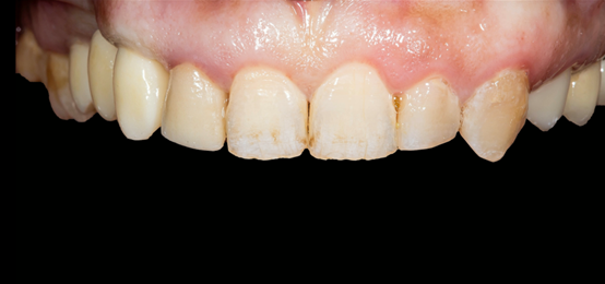 Fig. 15 - Final restorations in mouth (front side view)