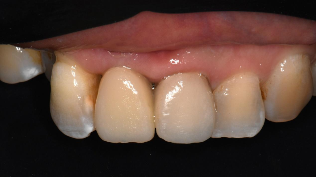 Implantation in anterior teeth