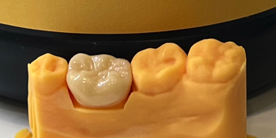 The printed model for posterior teeth restoration