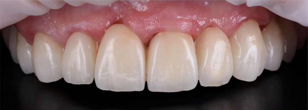The final restorations fixed in patients‘s mouth in the aspect for full mouth rehabilitation