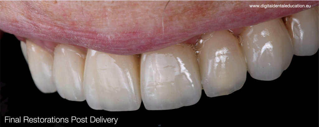 The final restorations fixed in patients‘s mouth in the aspect for full mouth rehabilitation