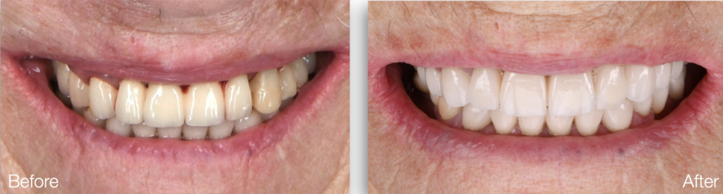 before and after the full mouth rehabilitation