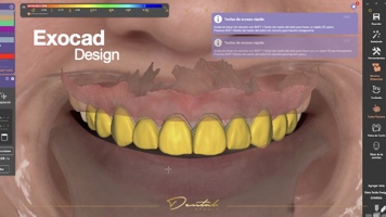 Digital dental smile in exocad