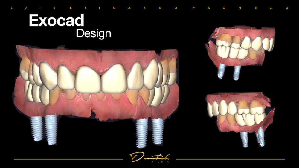 exocad design with SHINING 3D