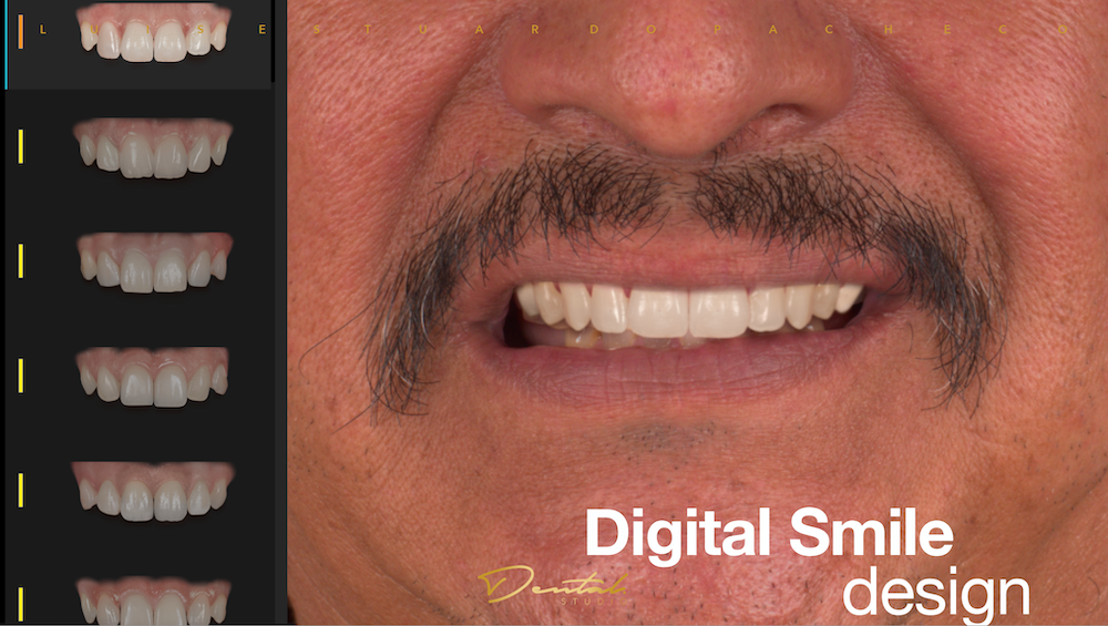 Digital Smile Design for patient