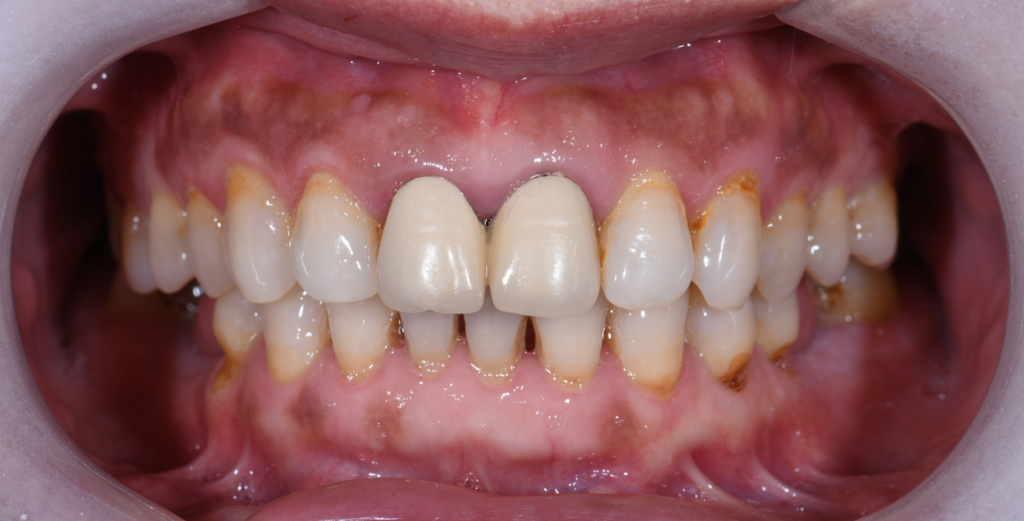 The intraoral situation before treatment