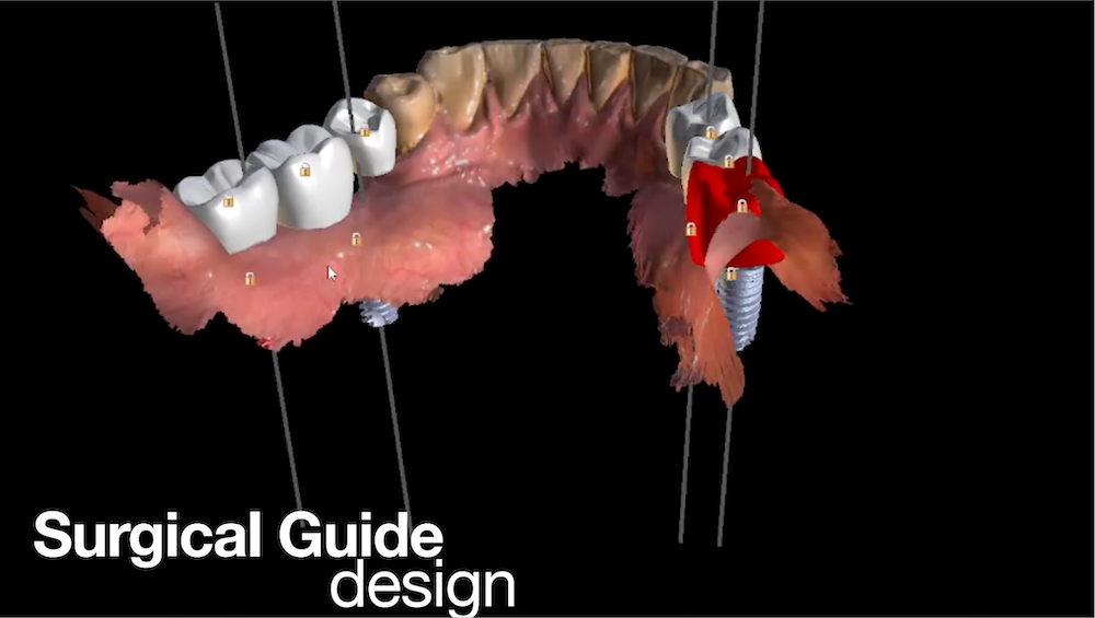 Surgical guide design for patients