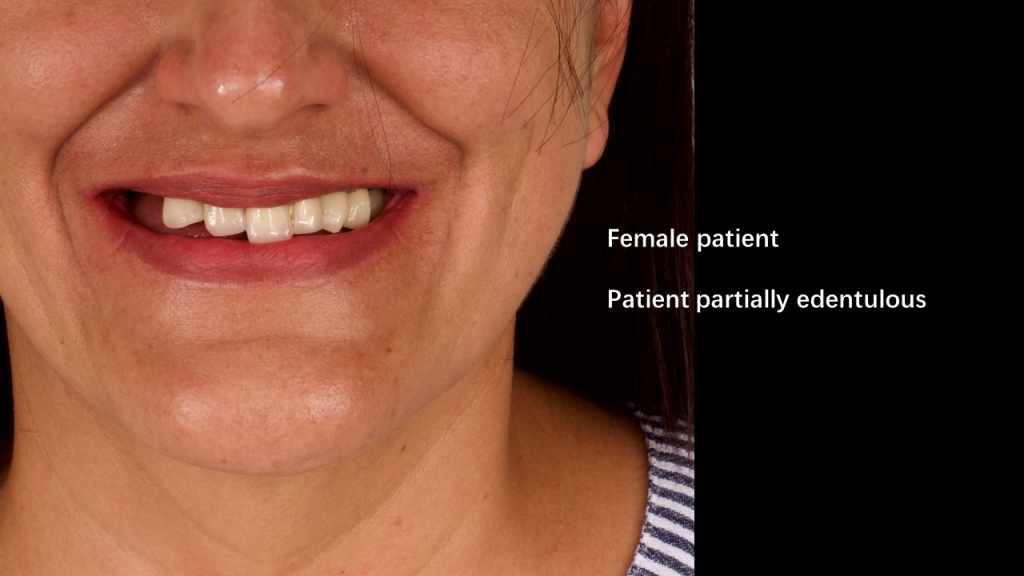 screw retained full denture case study
