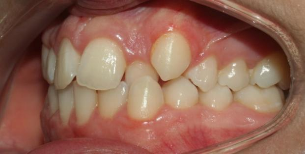 the intraoral condition before orthodontics treatment