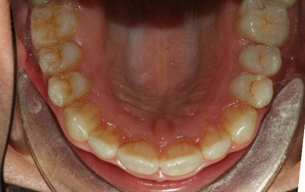 the intraoral condition after orthodontics treatment