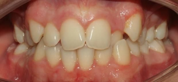 the intraoral condition before orthodontics treatment