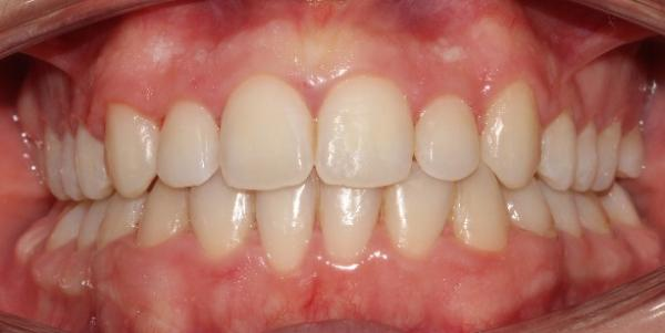 the intraoral condition before orthodontics treatment