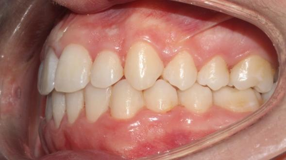 the intraoral condition after orthodontics treatment