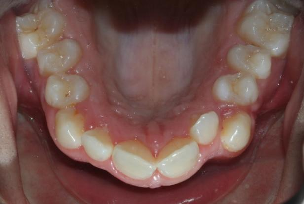 the intraoral condition after orthodontics treatment