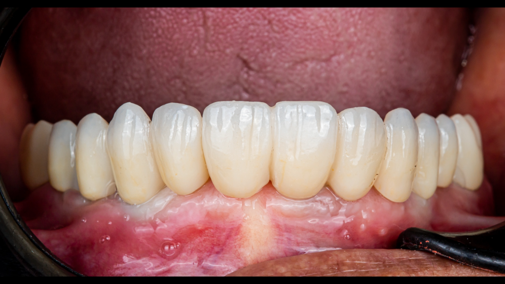 The result of teeth implant and restoration 