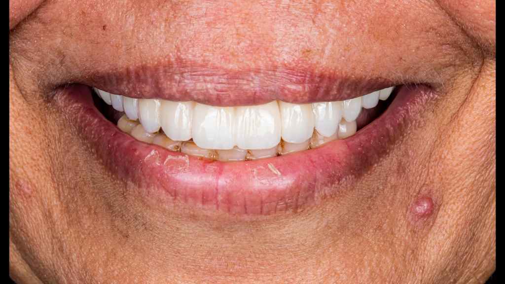 The result of teeth implant and restoration 
