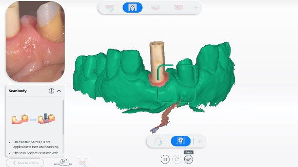 Intraoral scan data from Aoralscan 3