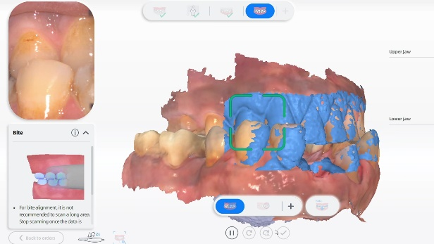 Intraoral scan data from Aoralscan 3