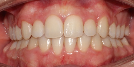 After orthodontic treatment 1