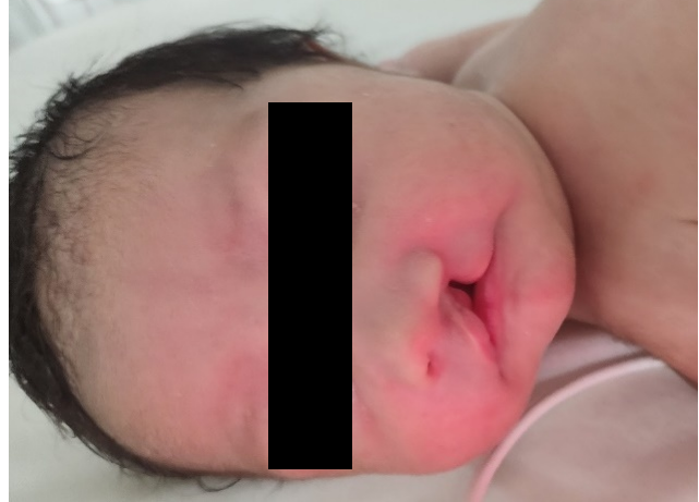 a diagnosis of complete bilateral cleft lip and palate