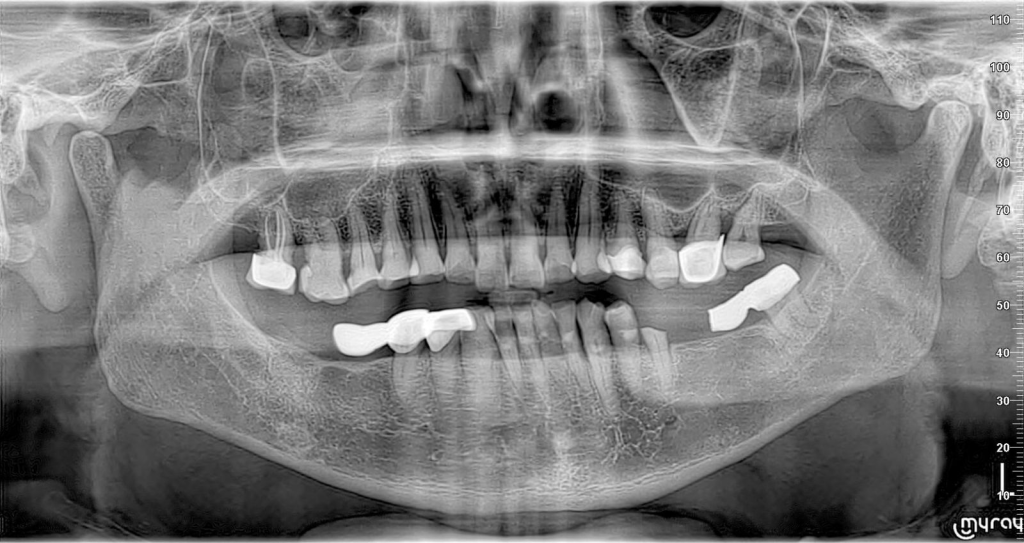 kế hoạch điều trị phục hồi chức năng toàn miệng