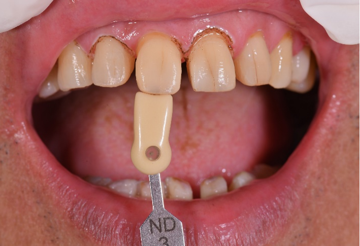 Choose suitable color for full-mouth rehabilitation