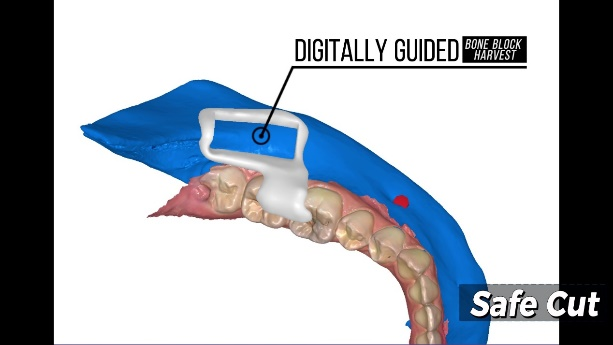 bone graft from posterior to anterior  mandible area