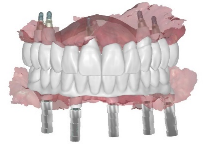 Restoration design for all-on-five implant treatment