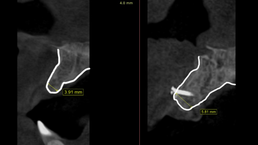 The CBCT result - before & after allogeneic bone graft