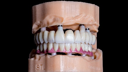 The zirconia teeth are well-prepared