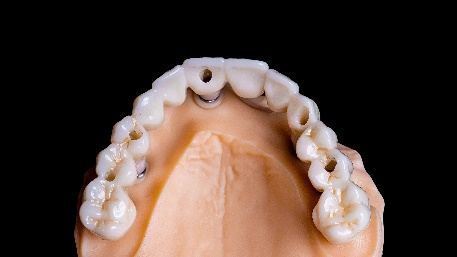 The zirconia teeth are well-prepared 