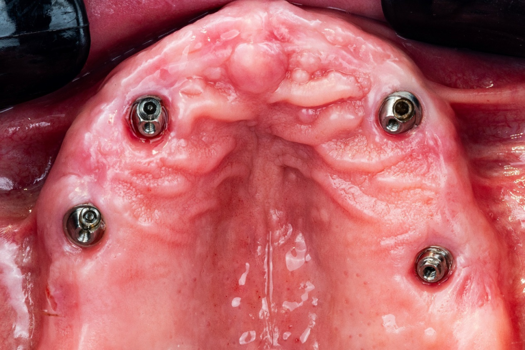 Oral health examination before permanent restoration