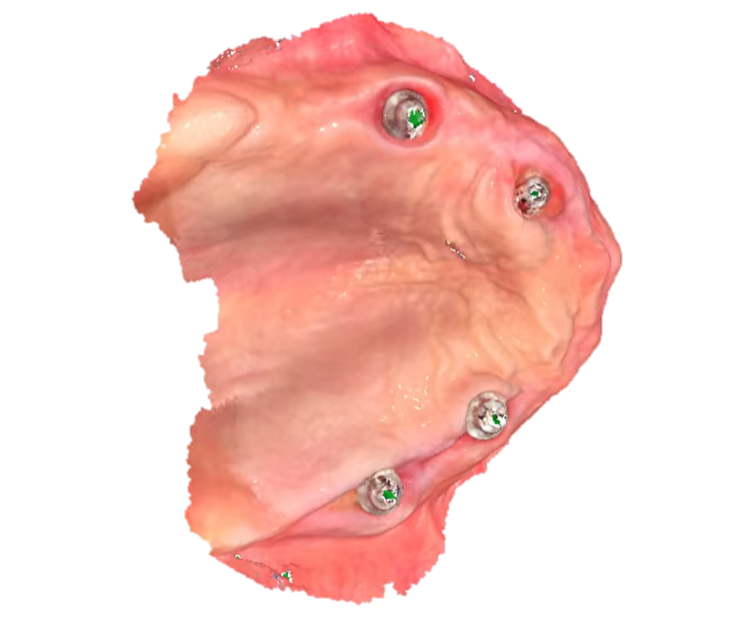 Scanned upper edentulous jaw