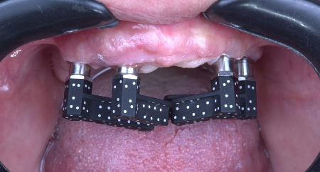 The coded scanbodies were placed in the patient's mouth