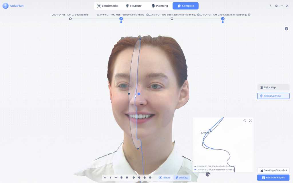 The sectional view to measure the changes by SHINING 3D MetiSmile