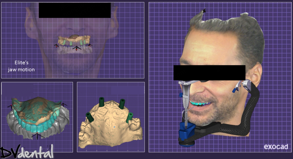 Design in exocad